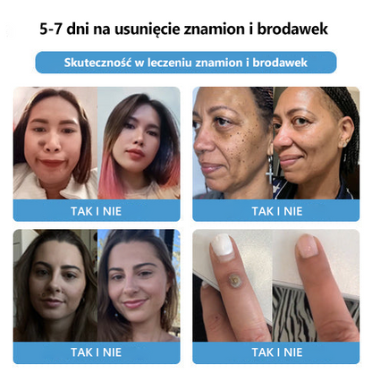 [🍀Oficjalny sklep marki🍀] 🐝🐝Lenaro™ Krem na znamiona i brodawki z jadem pszczelim(👨‍⚕AAD ZALECA)1