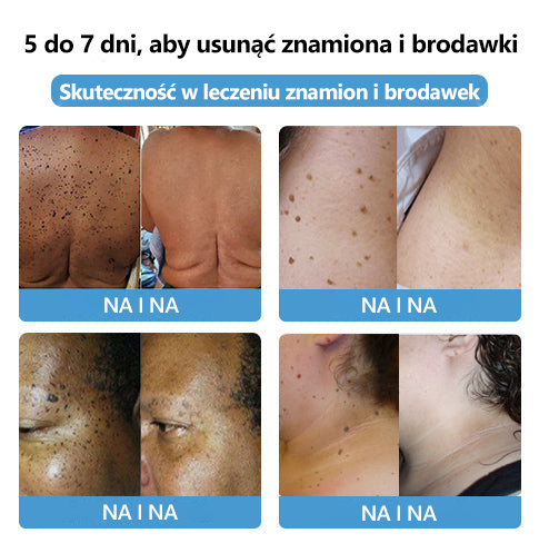 [🍀Oficjalny sklep marki🍀] 🐝🐝Lenaro™ Krem na znamiona i brodawki z jadem pszczelim(👨‍⚕AAD ZALECA)1