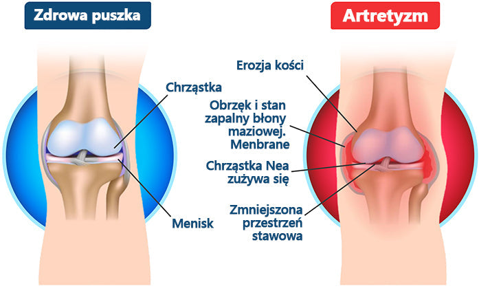 🍀🍀ArthroFree™ Krem na ból kości z jadem pszczelim🐝(Szczególnie dla osób starszych i zalecane przez AAOS) x