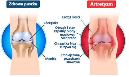 🍀🍀ArthroFree™ Krem na ból kości z jadem pszczelim🐝(Szczególnie dla osób starszych i zalecane przez AAOS) x