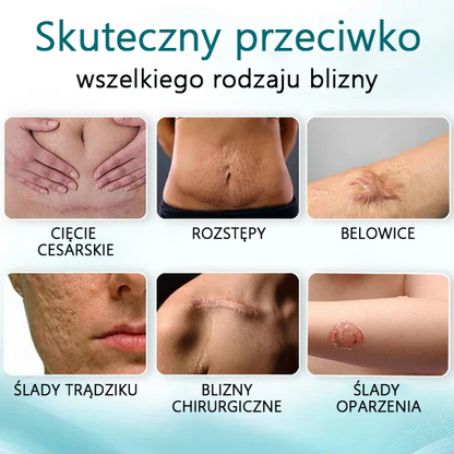 🌿Zaawansowany 💧LEFUN™ spray na blizny dla wszystkich typów blizn - na przykład blizny po trądziku, blizny pooperacyjne i rozstępy