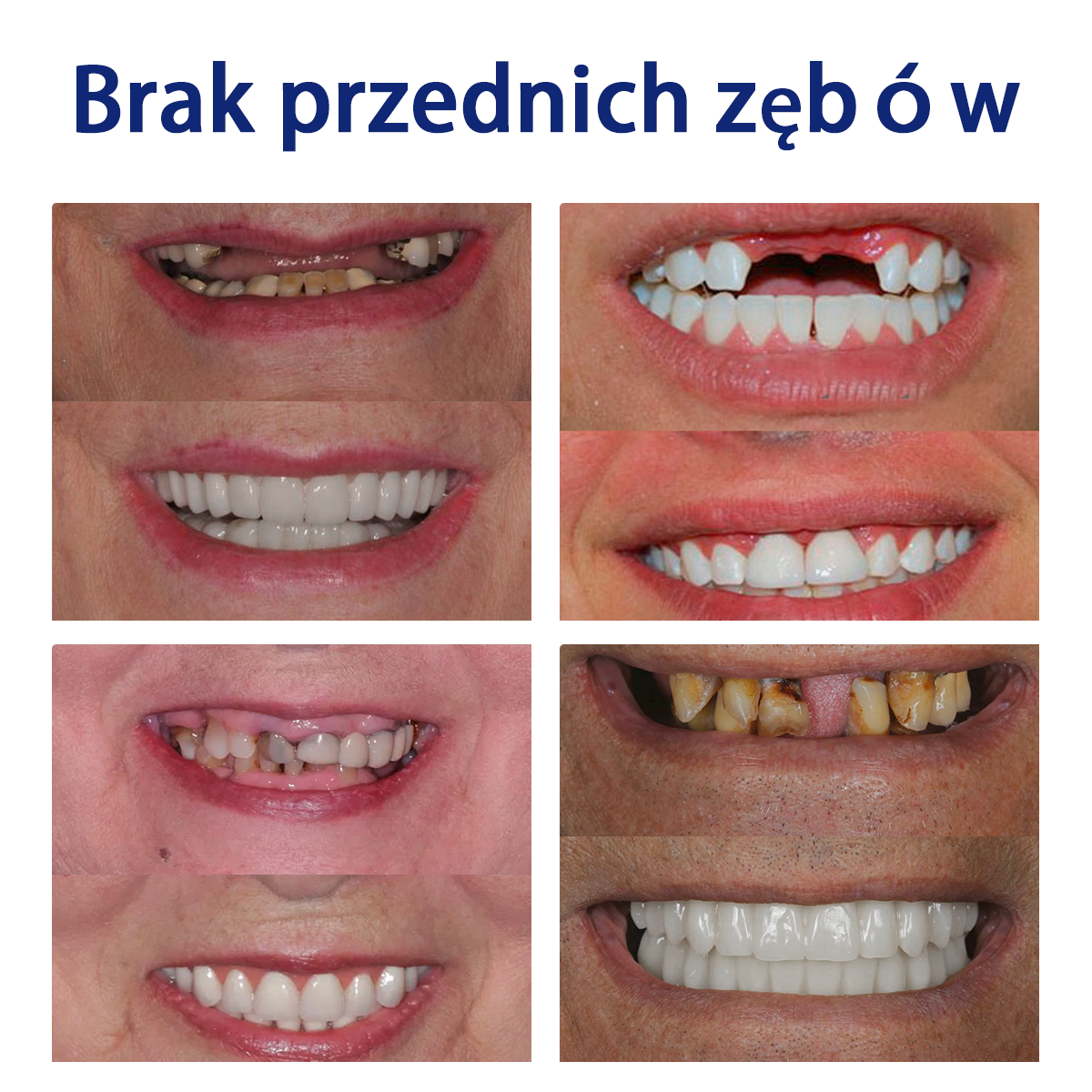 Bikenda™ Silikonowy Zestaw Do Mierzenia Protez 🧨🧨 (👩‍🔬 Zgodny z CED, zatwierdzony przez profesjonalnych dentystów)