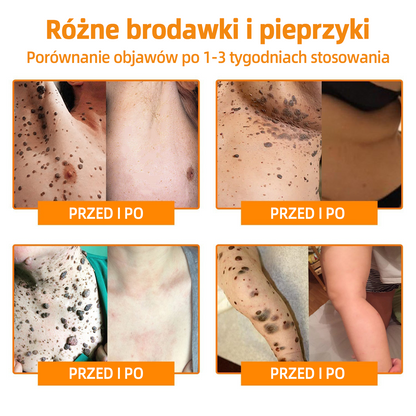 🎉🎉 LIPOGO™ Krem do usuwania brodawek i znaczników z jadem pszczelim(👨‍⚕Suitable dla wszystkich rodzajów skóry)🐝(🔥Ostatni dzień promocji 70% taniej)