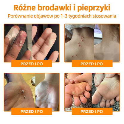 🎉🎉 LIPOGO™ Krem do usuwania brodawek i znaczników z jadem pszczelim(👨‍⚕Suitable dla wszystkich rodzajów skóry)🐝(🔥Ostatni dzień promocji 70% taniej)