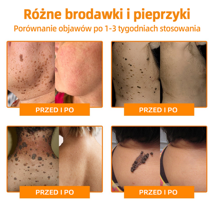 🎉🎉 LIPOGO™ Krem do usuwania brodawek i znaczników z jadem pszczelim(👨‍⚕Suitable dla wszystkich rodzajów skóry)🐝(🔥Ostatni dzień promocji 70% taniej)