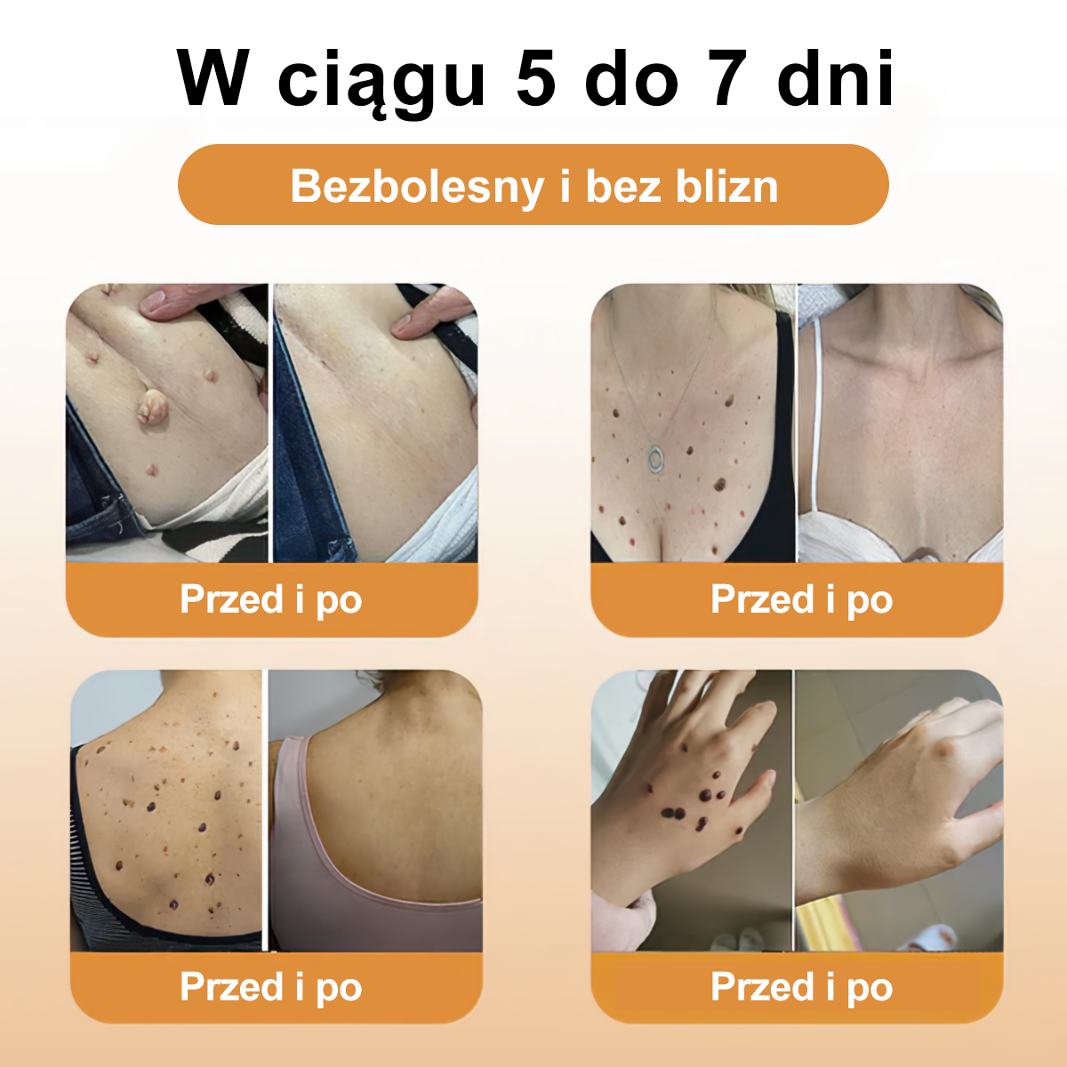 👨‍⚕️👨‍⚕️[✨Oficjalny Sklep Marki✨] 𝐙𝐨𝐞𝐧𝐜𝐠𝐳™ Krem do Leczenia Kretów i Brodawek Jadu Pszczelego(👨‍⚕EADV POLECA)