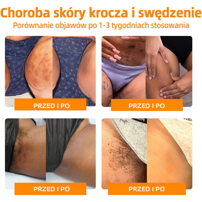 🎉🎉 LIPOGO™ Krem do usuwania brodawek i znaczników z jadem pszczelim(👨‍⚕Suitable dla wszystkich rodzajów skóry)🐝(🔥Ostatni dzień promocji 70% taniej)