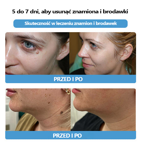 [🍀Oficjalny sklep marki🍀] 🐝🐝Lenaro™ Krem na znamiona i brodawki z jadem pszczelim(👨‍⚕AAD ZALECA)1