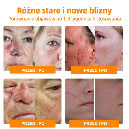 🎉🎉 LIPOGO™ Krem do usuwania brodawek i znaczników z jadem pszczelim(👨‍⚕Suitable dla wszystkich rodzajów skóry)🐝(🔥Ostatni dzień promocji 70% taniej)