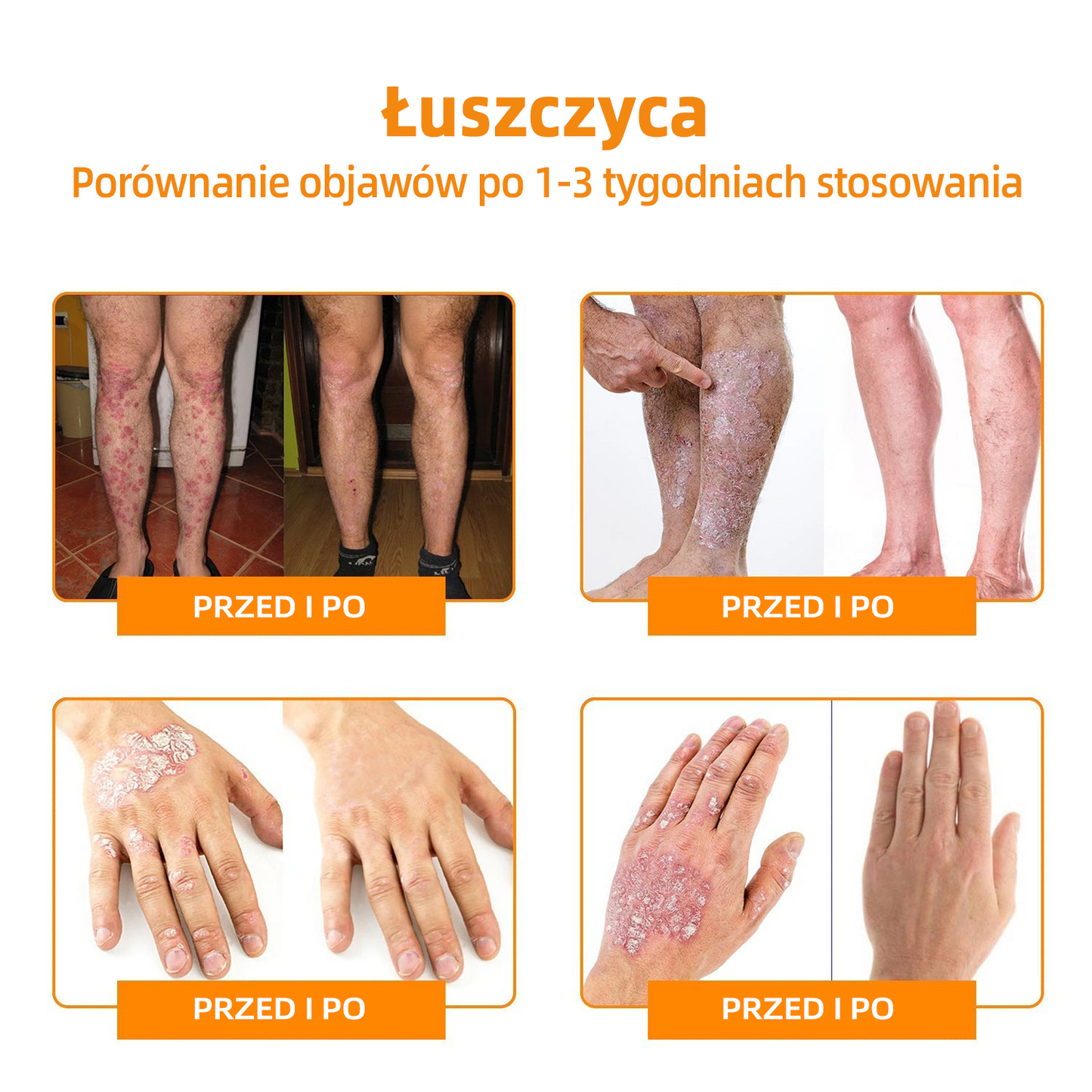 🎉🎉 LIPOGO™ Krem do usuwania brodawek i znaczników z jadem pszczelim(👨‍⚕Suitable dla wszystkich rodzajów skóry)🐝(🔥Ostatni dzień promocji 70% taniej)